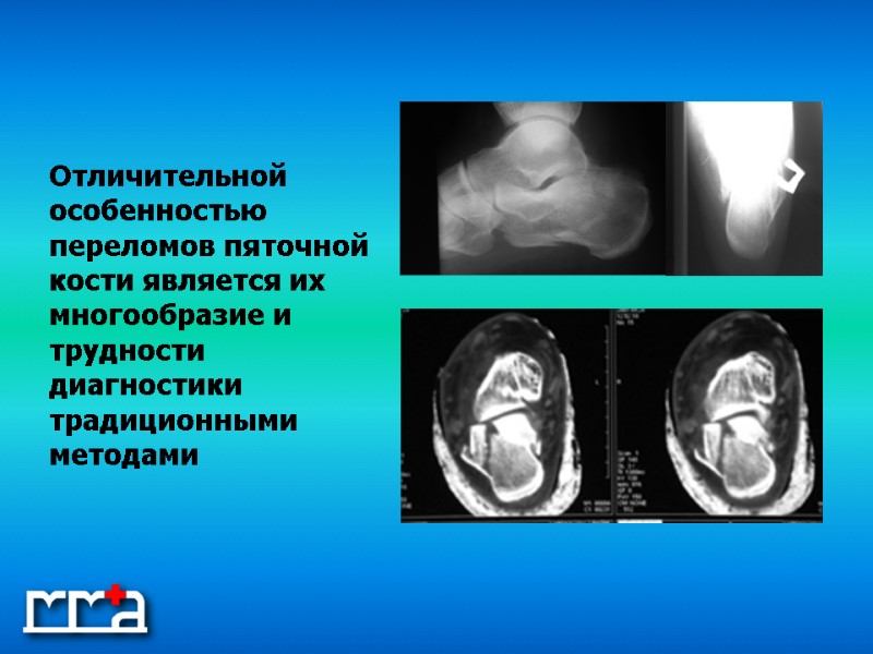 Отличительной особенностью переломов пяточной кости является их многообразие и трудности диагностики традиционными методами